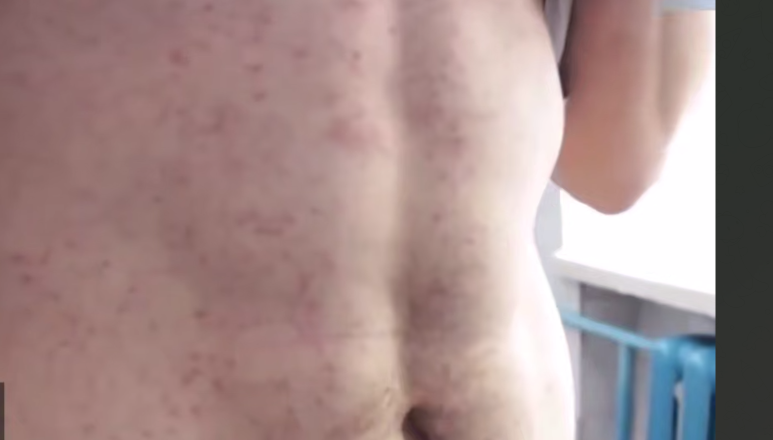 В Хабаровске жители целого подъезда многоэтажки заболели корью 