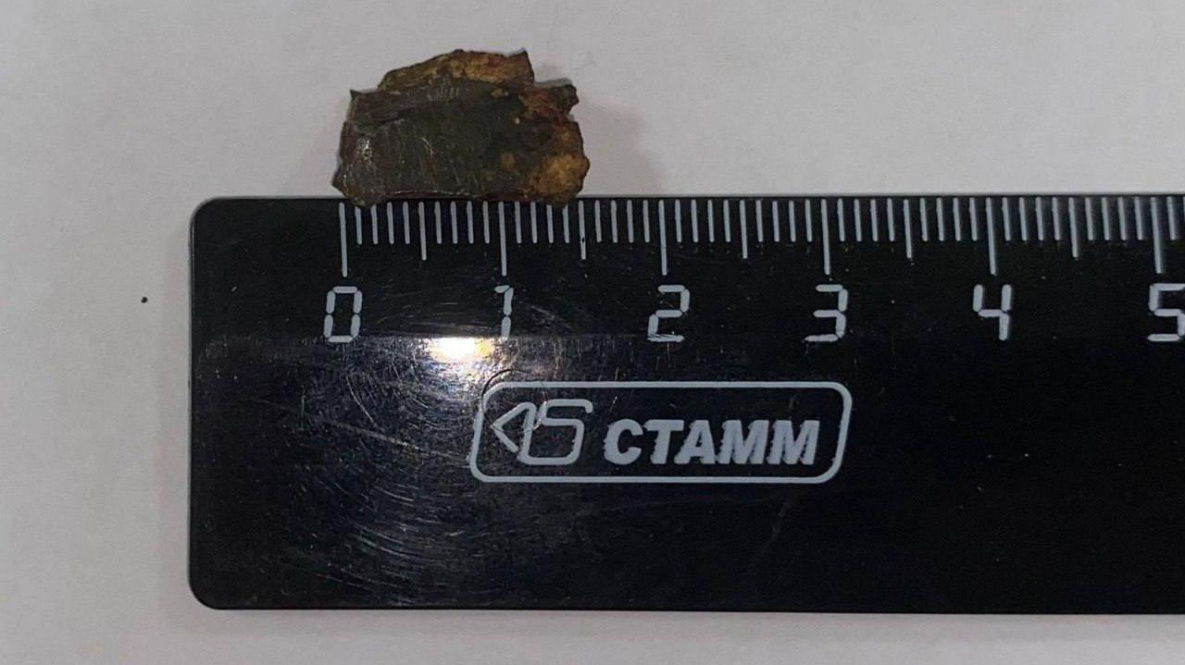 Хабаровские врачи виртуозно вытащили опасный осколок из тела бойца СВО